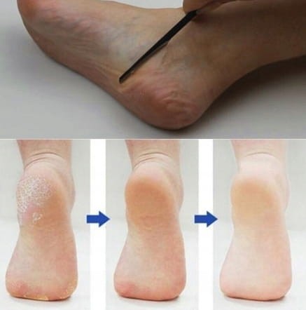 Ścinak do pięt | pedicure